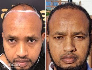 afro hair transplant turkey before after photo 3