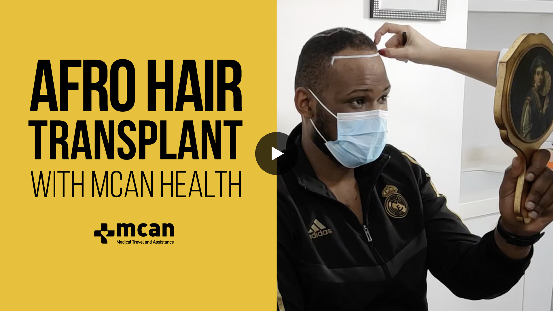 4000 Hair Grafts Afro Hair Transplant Turkey - Nicholas from Netherlands