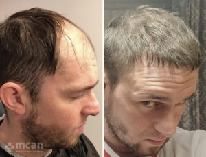 Sapphire Hair Transplant Results 3