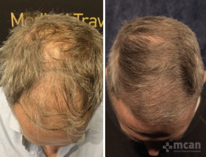 Sapphire Hair Transplant Results 4