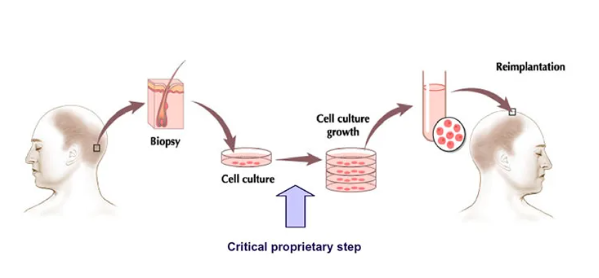 clone hair transplant