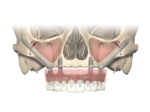 Zygomatic Implants: