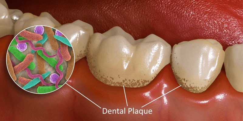 dental plaque bacteria 2
