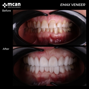 hollywood smile before after 10