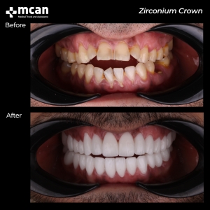 hollywood smile before after 11