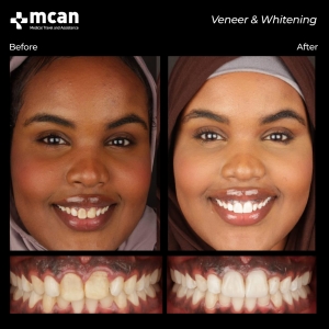 hollywood smile before after 19