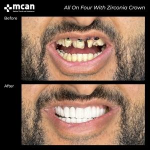 hollywood smile before after 4