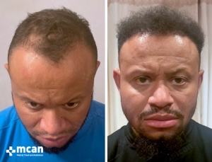 afro hair transplant turkey before after photo 4