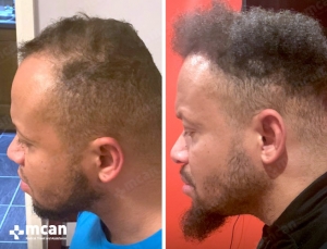 afro hair transplant turkey before after photo 5