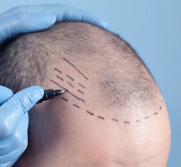 What You Shouldn't Expect From Sapphire FUE Hair Transplant