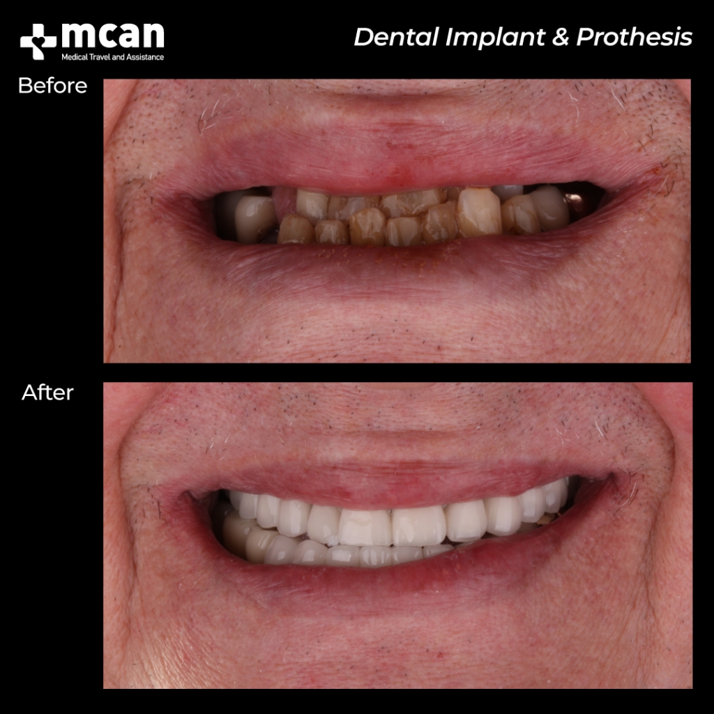 dental implante foto 1