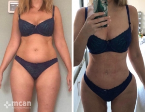 foto de liposuccion turquia antes despues 15