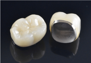 Metal Porcelain Crowns