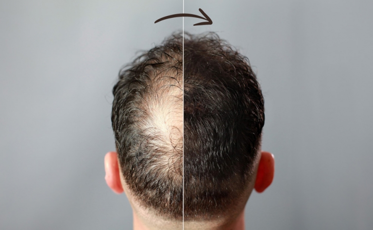 How to Thicken Hair? Shake up Your Routine! 2 THICKEN HAIR 2 photo of how to thicken hair