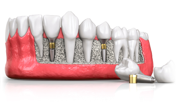 what is dental implant 1