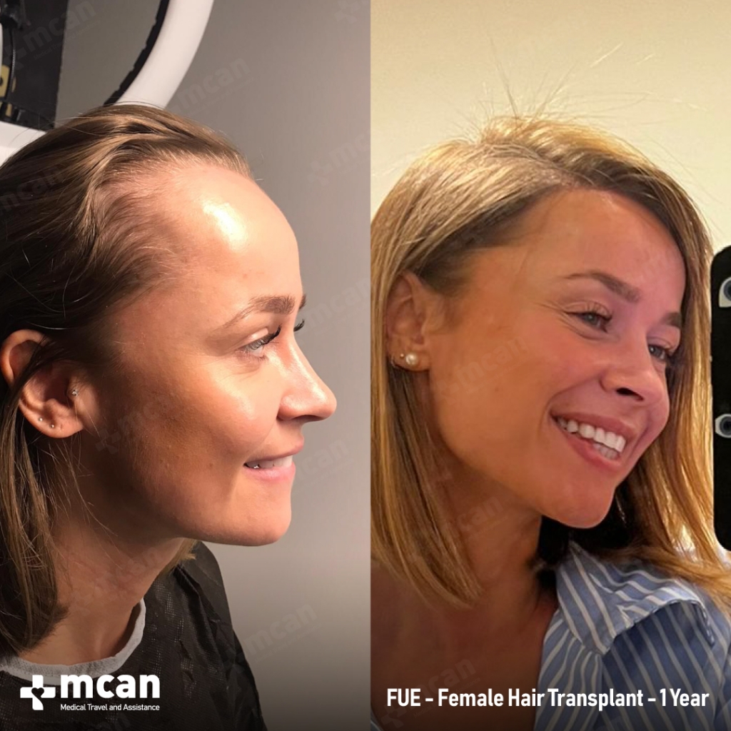 mcan health hair transplant before after 4