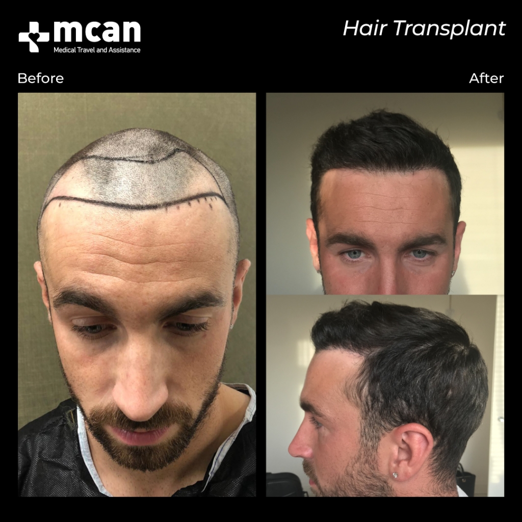 mcan health's hair transplant before after