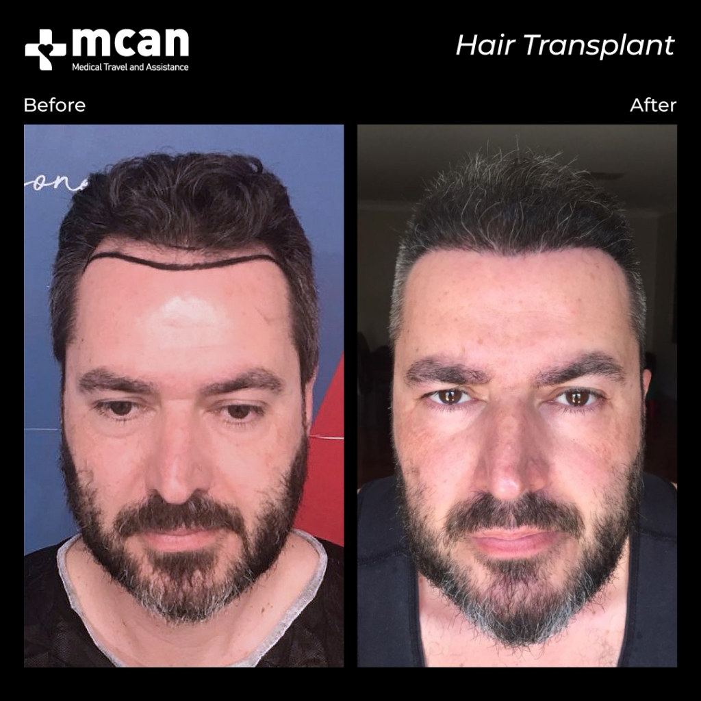 hair transplant before and after with mcan health 2