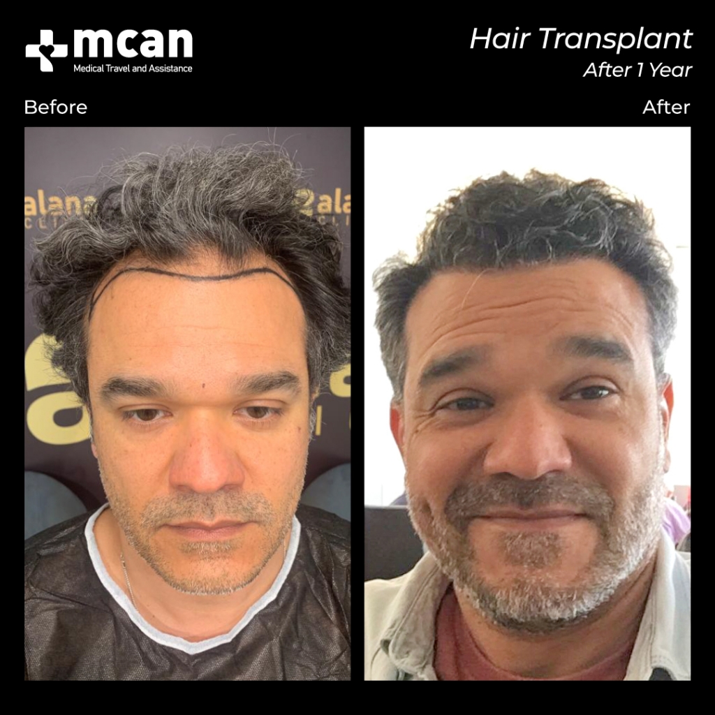 mcan health's hair transplant before after 2