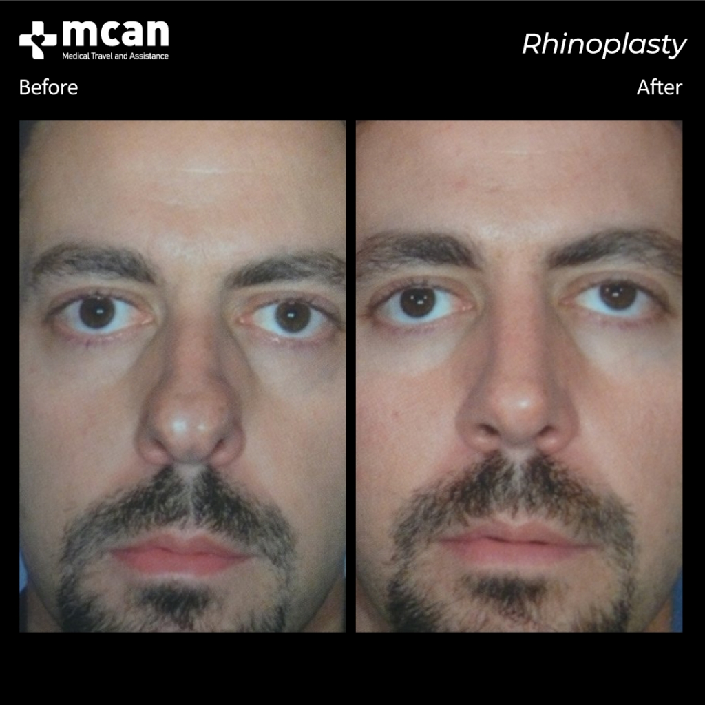 rinoplastia antes y despues MCAN Health 2