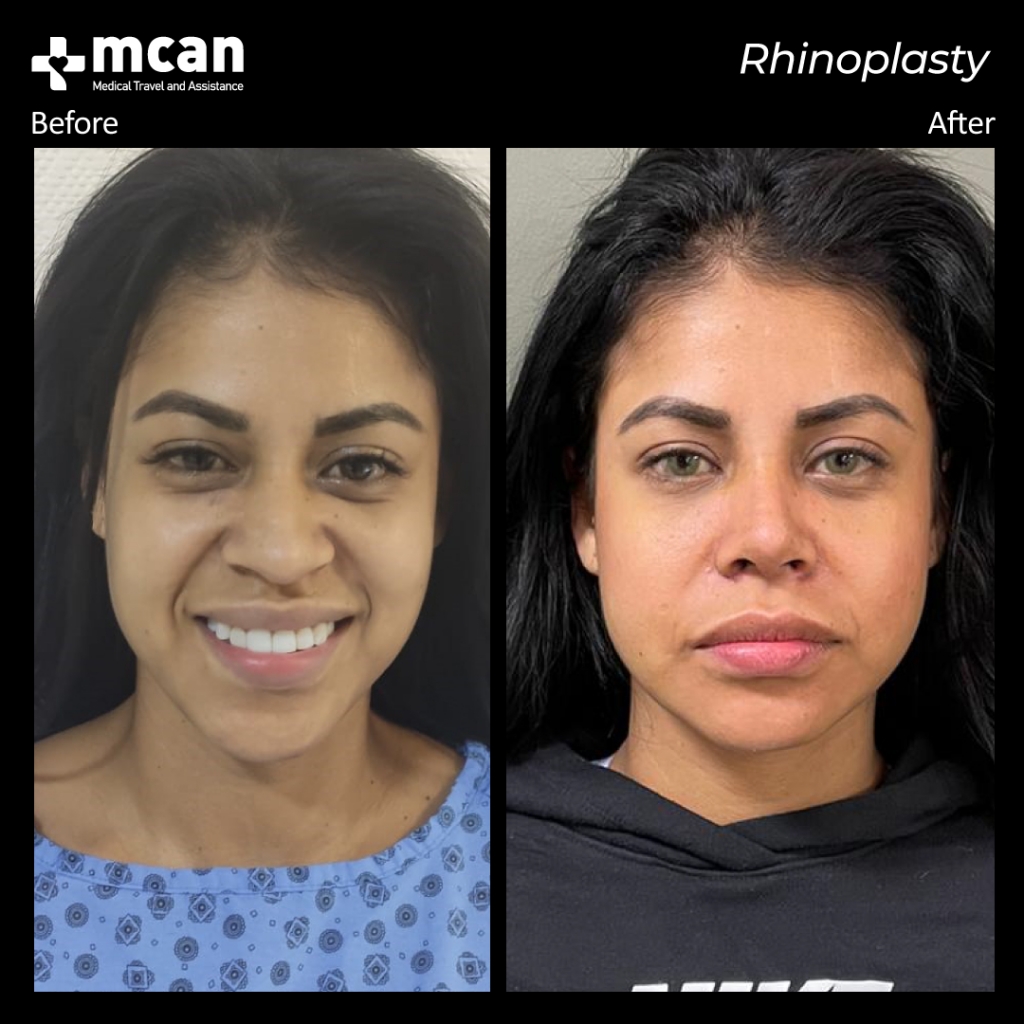 rinoplastia antes y despues MCAN Health 1