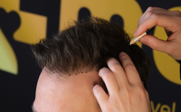 How Many Hair Transplants Can a Person Have? 10 How Many Hair Transplants Can a Person Have How Many Hair Transplants Can a Person Have
