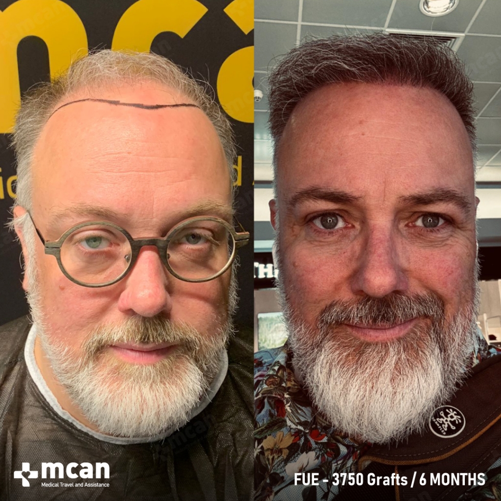 mcan health hair transplant before after 5