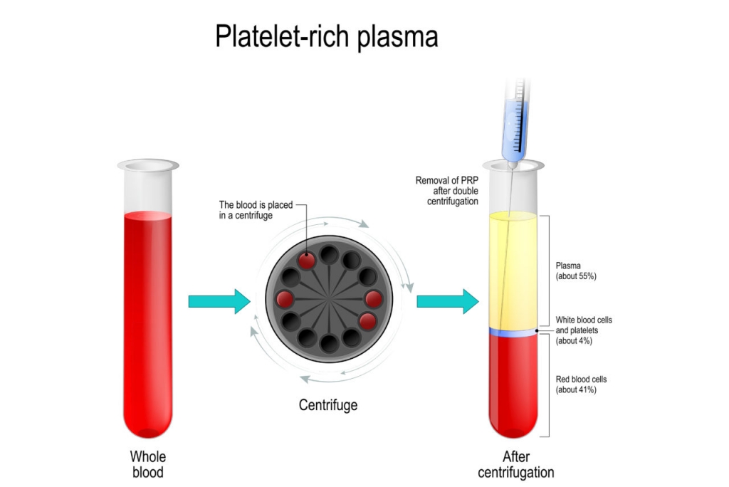 PRP therapy description for receding hairline men