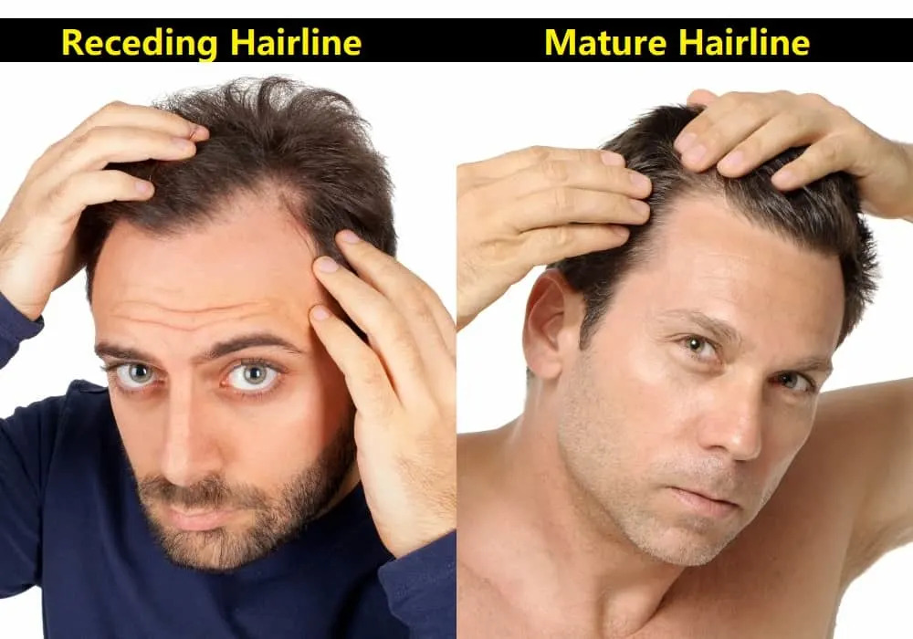 mature hairline vs receding