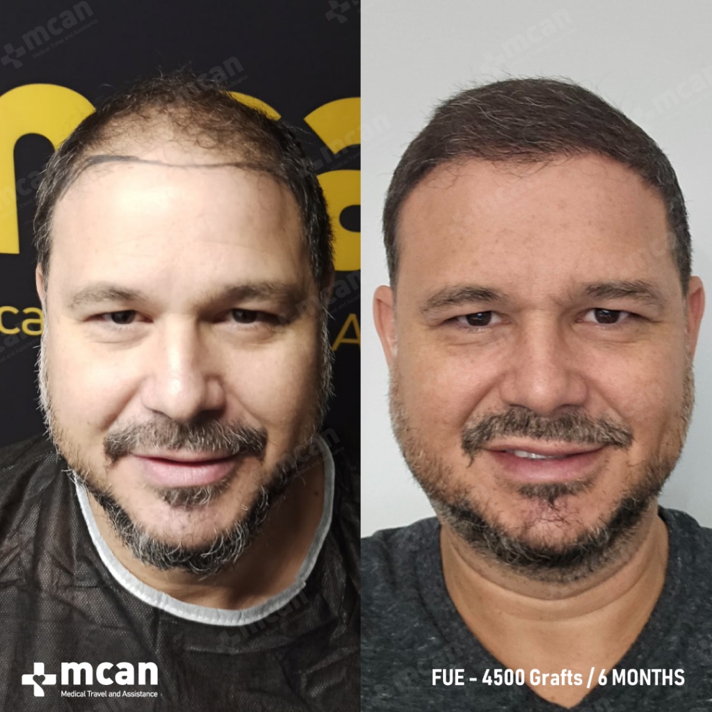 hair transplant before and after with mcan health 3 