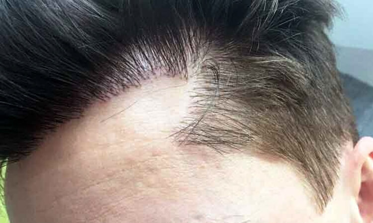 bad hair transplant picture