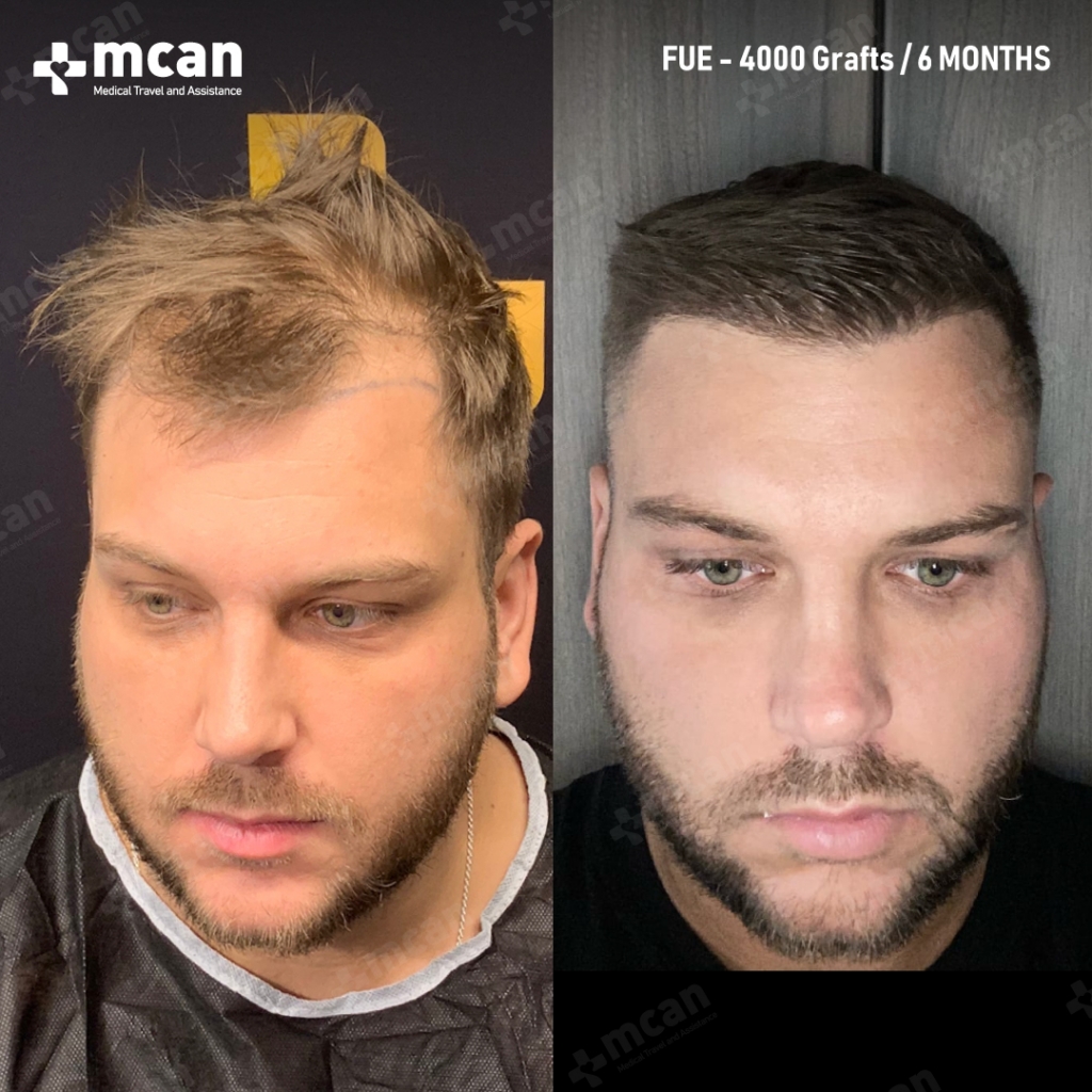 mcan health hair transplant before aftermcan health hair transplant before after 3