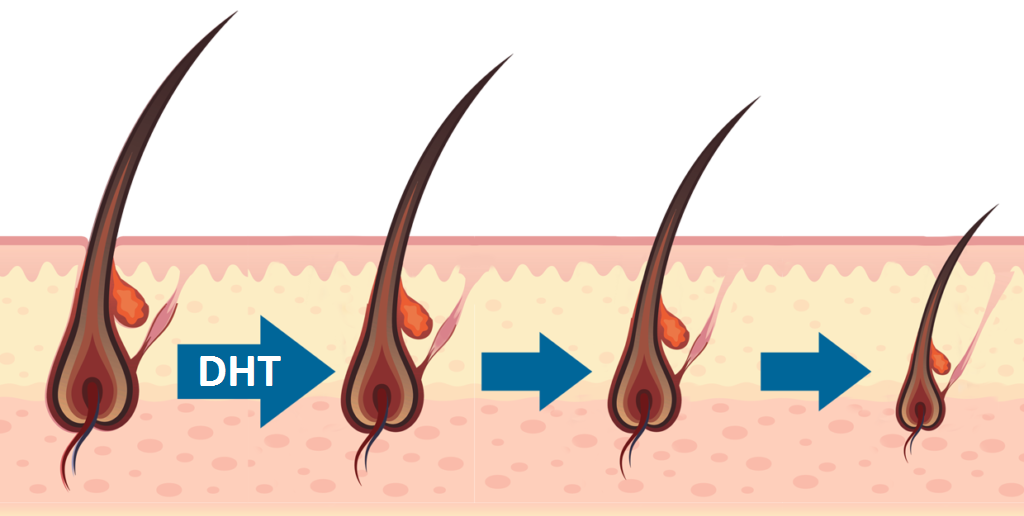 dht hormone causing hair loss