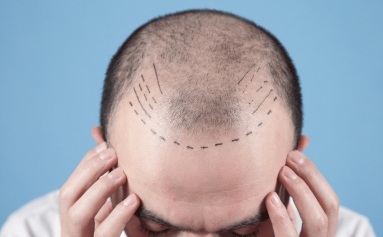 How to Stop Receding Hairline: Causes & Treatment 12 hair loss image2 a blog about a receding hairline and its solutions