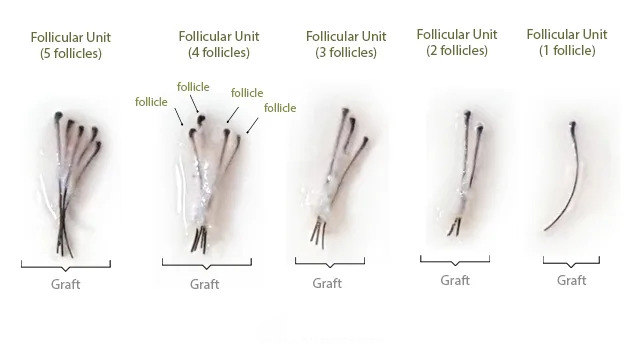 hair transplant follicle