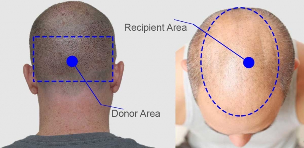 recipient and donor area for second hair transplant