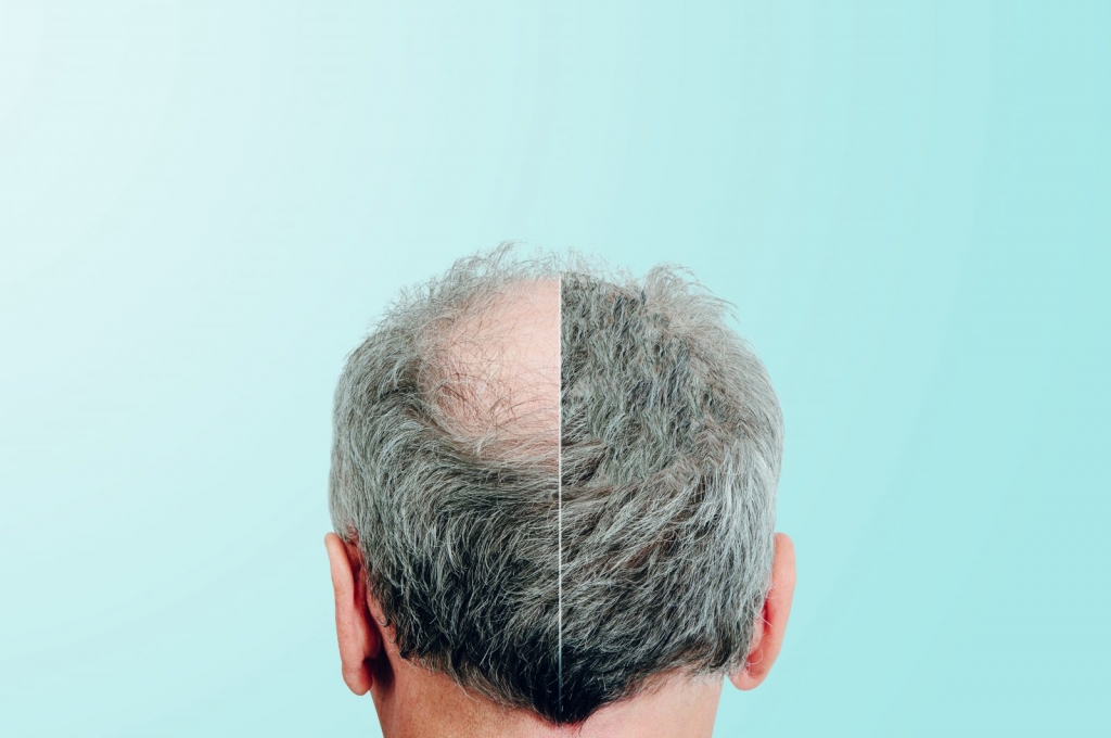 hair transplant procedure 