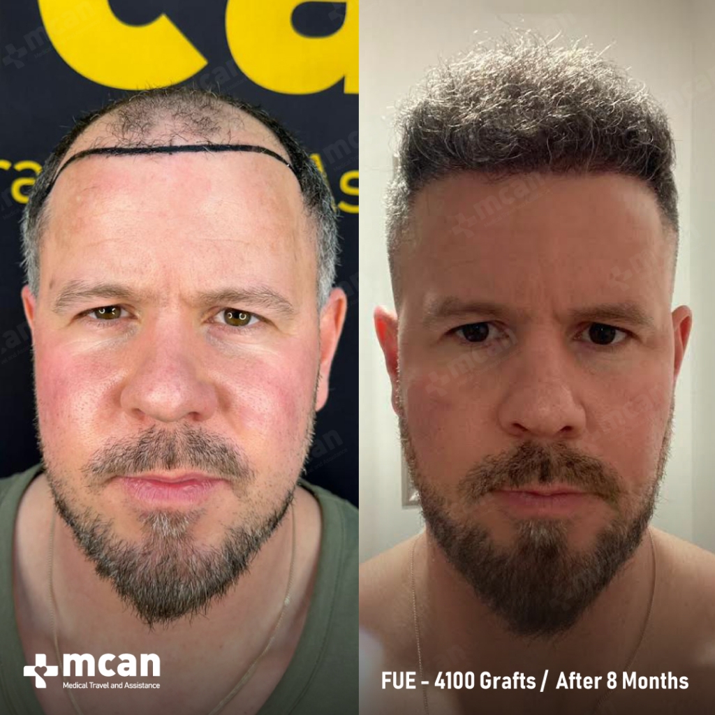 mcan health hair transplant before after 6