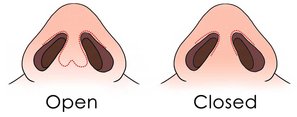 rinoplastia abierta o cerrada