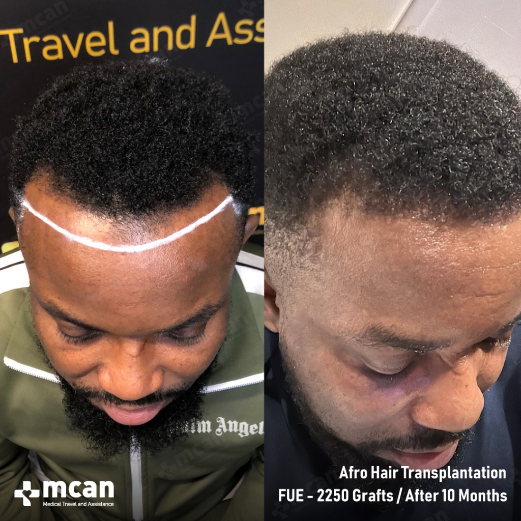 mcan health hair transplant before after 2