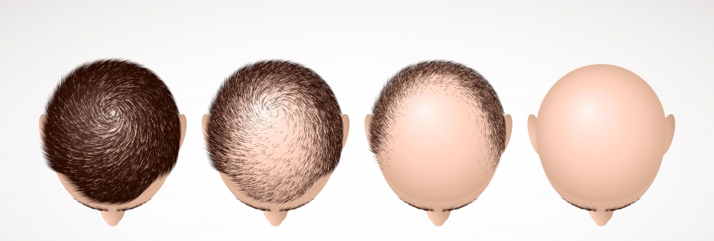 hair receding scale 