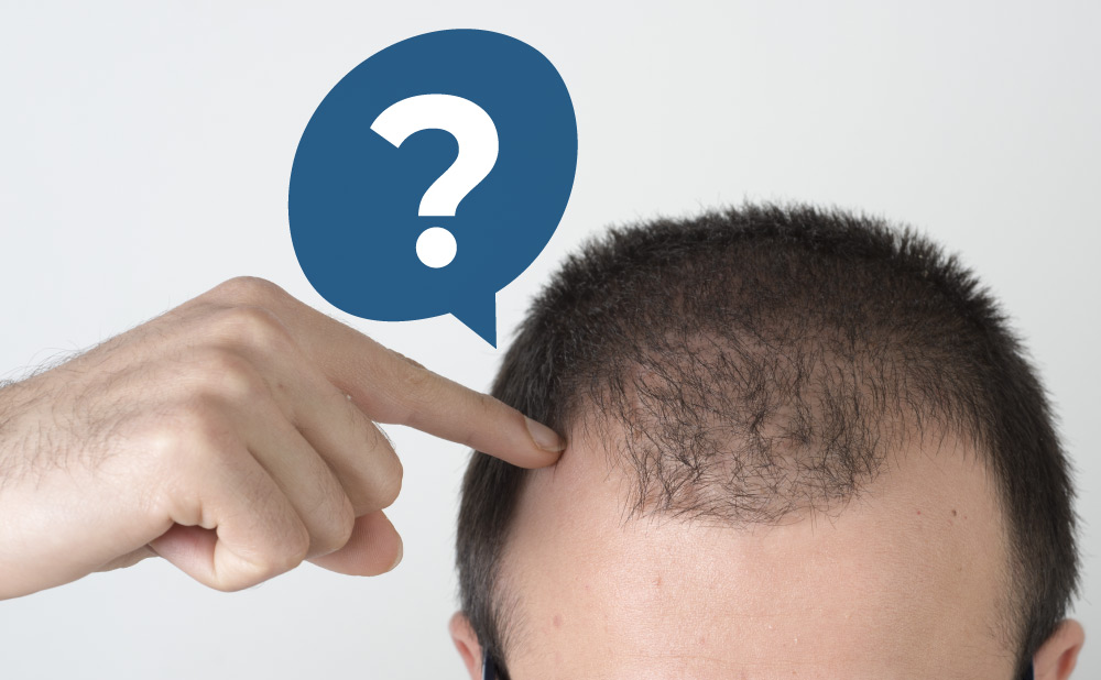 hair shedding after hair transplant blog