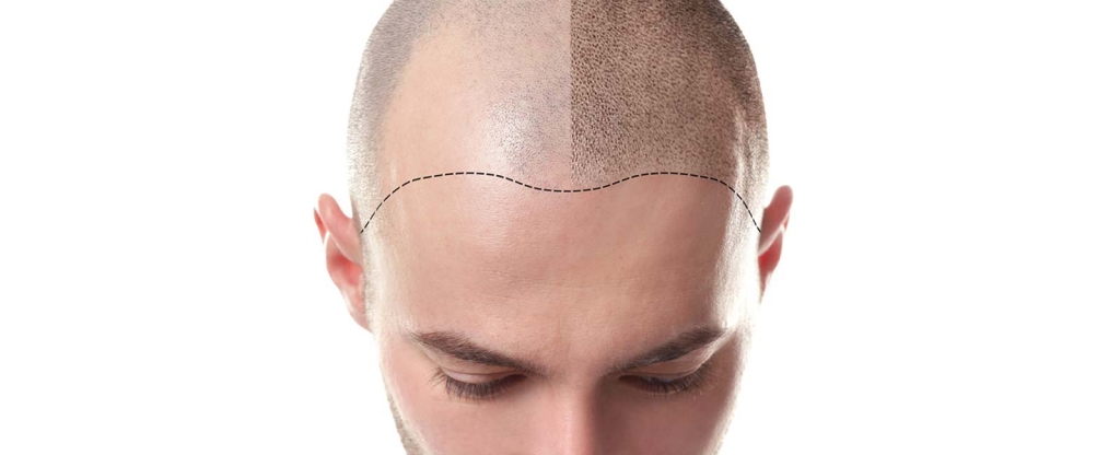 hair transplant affect 