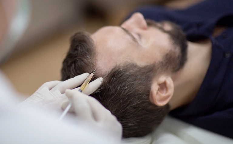 Mesotherapy for Hair: A Practical Treatment 7 mesotheraphy 2 1 mesotheraphy in turkey with mcan health