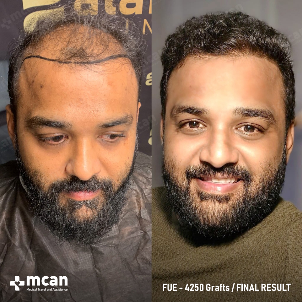 Balaji Thangaraj FUE Hair Transplant Before After