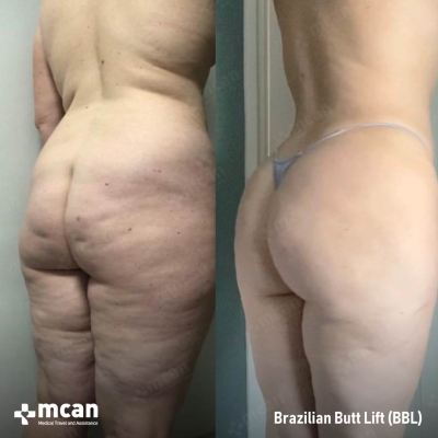 Actual MCAN Health patient: BBL Result