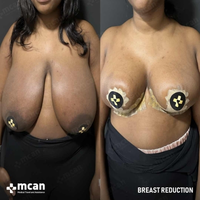 Actual MCAN Health patient: Breast Reduction Result