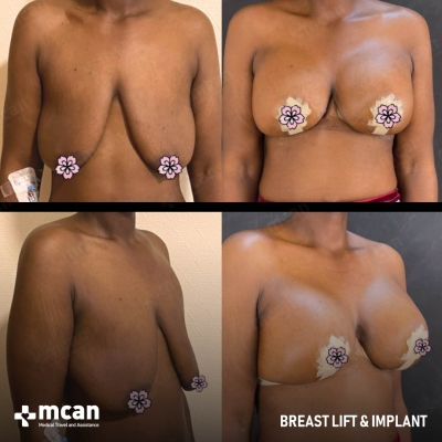 Actual MCAN Health patient: Breast Uplift Result