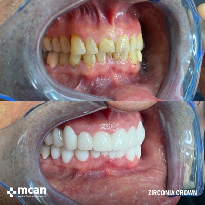 Actual MCAN Health patient: Dental Crown Result