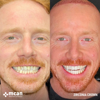 Actual MCAN Health patient: Dental Crown Result